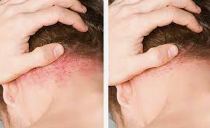 The Australian Luxury - ScalpLux + Shampoo with Batana Oil - For More Targeted Psoriasis, Eczema, Itching, Sores, Scabs and Dandruff