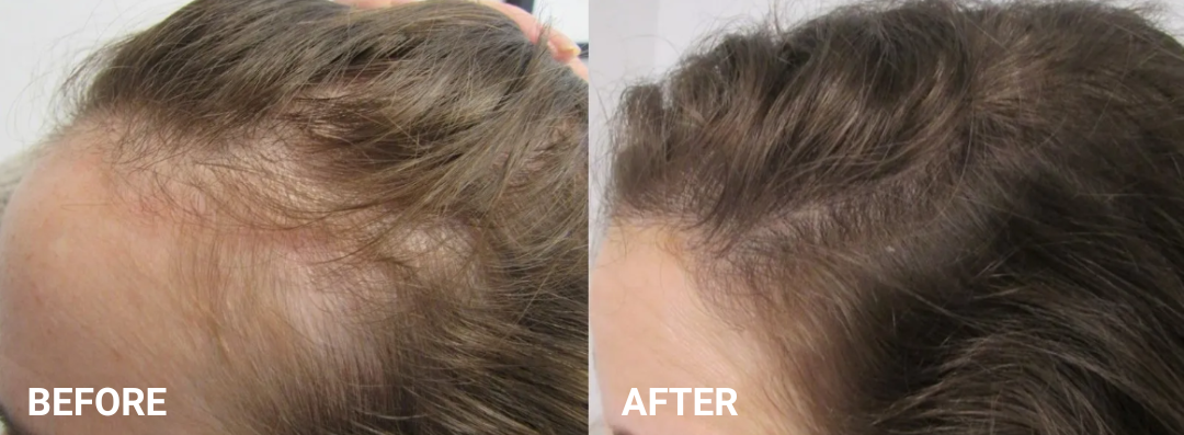 The Australian Luxury - Grow Mode + Conditioner - For More Targeted Hair Loss and Faster Hair Growth with Batana Oil